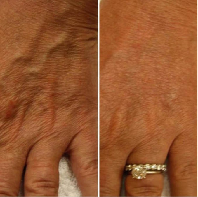 Before and after: Treated for crepey skin, wrinkles, and loss of elasticity on the hands.