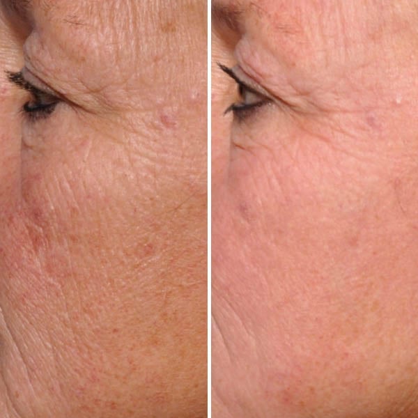 Before and after: Treated for fine lines, crow's feet, and skin texture.