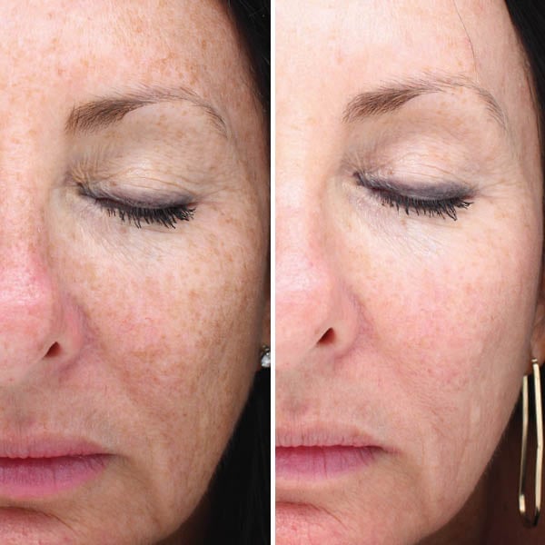 Before and after: Treated for freckles, sun spots, and hyperpigmentation.