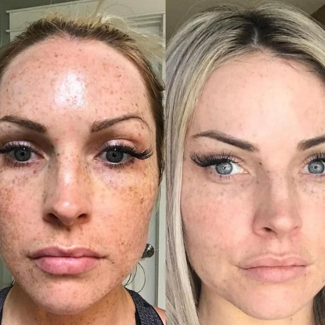 Before and after: Treated for freckles, sun damage, and pigmentation.